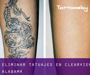 Eliminar tatuajes en Clearview (Alabama)