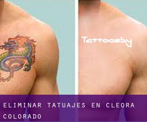 Eliminar tatuajes en Cleora (Colorado)