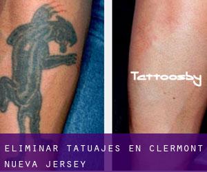 Eliminar tatuajes en Clermont (Nueva Jersey)