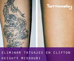Eliminar tatuajes en Clifton Heights (Missouri)