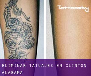 Eliminar tatuajes en Clinton (Alabama)