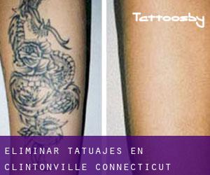 Eliminar tatuajes en Clintonville (Connecticut)