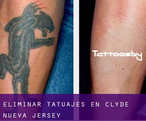 Eliminar tatuajes en Clyde (Nueva Jersey)
