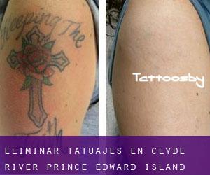 Eliminar tatuajes en Clyde River (Prince Edward Island)