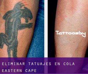 Eliminar tatuajes en Cola (Eastern Cape)