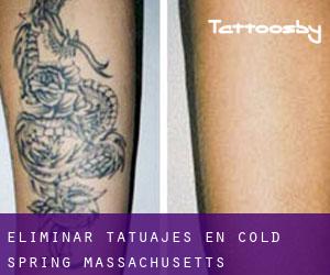Eliminar tatuajes en Cold Spring (Massachusetts)