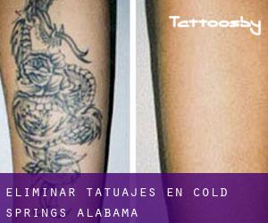 Eliminar tatuajes en Cold Springs (Alabama)