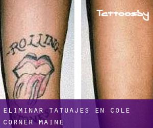 Eliminar tatuajes en Cole Corner (Maine)