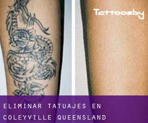 Eliminar tatuajes en Coleyville (Queensland)
