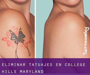 Eliminar tatuajes en College Hills (Maryland)