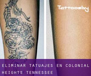 Eliminar tatuajes en Colonial Heights (Tennessee)