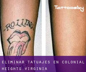 Eliminar tatuajes en Colonial Heights (Virginia)