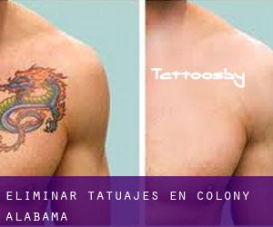 Eliminar tatuajes en Colony (Alabama)
