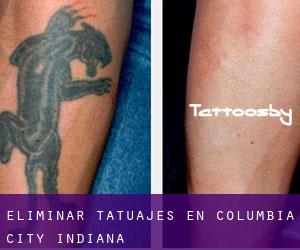 Eliminar tatuajes en Columbia City (Indiana)