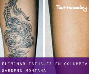 Eliminar tatuajes en Columbia Gardens (Montana)