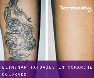 Eliminar tatuajes en Comanche (Colorado)
