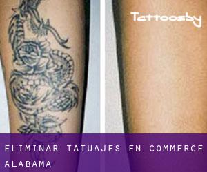 Eliminar tatuajes en Commerce (Alabama)