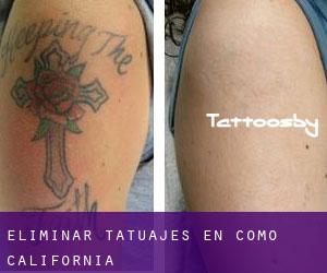 Eliminar tatuajes en Como (California)