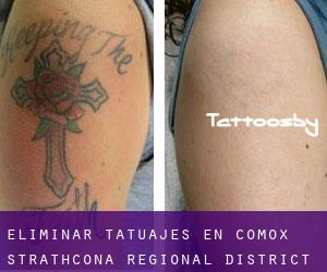 Eliminar tatuajes en Comox-Strathcona Regional District