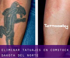 Eliminar tatuajes en Comstock (Dakota del Norte)