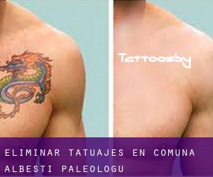Eliminar tatuajes en Comuna Albeşti-Paleologu