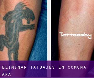 Eliminar tatuajes en Comuna Apa