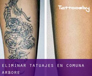 Eliminar tatuajes en Comuna Arbore