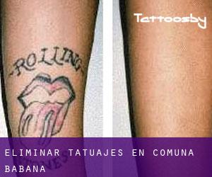 Eliminar tatuajes en Comuna Băbana