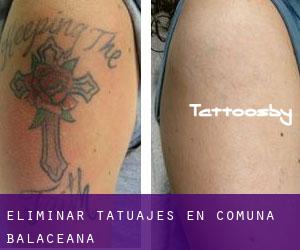 Eliminar tatuajes en Comuna Bălăceana