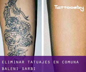 Eliminar tatuajes en Comuna Băleni Sârbi