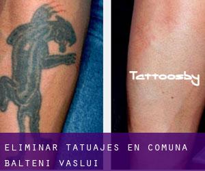 Eliminar tatuajes en Comuna Bălteni (Vaslui)
