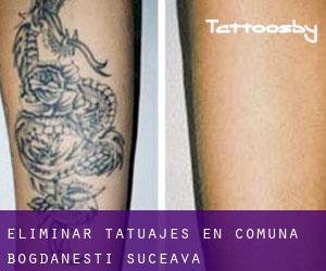 Eliminar tatuajes en Comuna Bogdăneşti (Suceava)