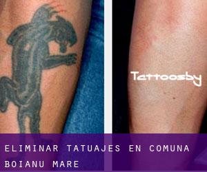 Eliminar tatuajes en Comuna Boianu Mare