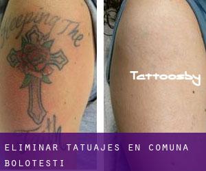 Eliminar tatuajes en Comuna Boloteşti