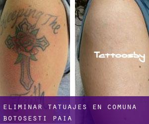 Eliminar tatuajes en Comuna Botoşeşti-Paia