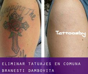 Eliminar tatuajes en Comuna Brăneşti (Dâmboviţa)