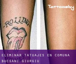 Eliminar tatuajes en Comuna Bucşani (Giurgiu)