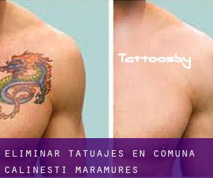 Eliminar tatuajes en Comuna Călineşti (Maramureş)