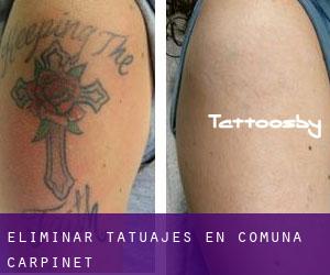 Eliminar tatuajes en Comuna Cărpinet