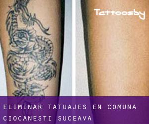 Eliminar tatuajes en Comuna Ciocăneşti (Suceava)