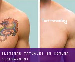 Eliminar tatuajes en Comuna Ciofrângeni