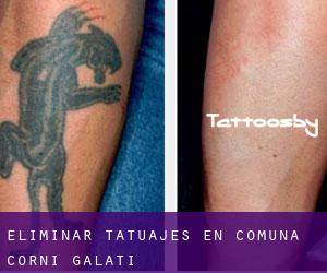 Eliminar tatuajes en Comuna Corni (Galaţi)