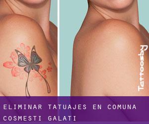Eliminar tatuajes en Comuna Cosmeşti (Galaţi)