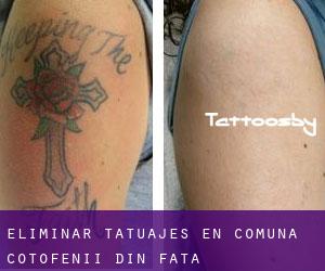 Eliminar tatuajes en Comuna Coţofenii din Faţă