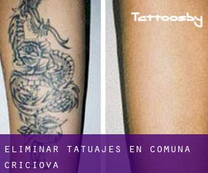 Eliminar tatuajes en Comuna Criciova