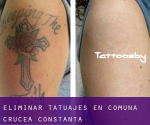 Eliminar tatuajes en Comuna Crucea (Constanţa)