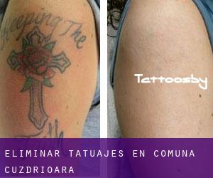 Eliminar tatuajes en Comuna Cuzdrioara