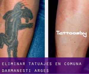 Eliminar tatuajes en Comuna Dărmăneşti (Argeş)
