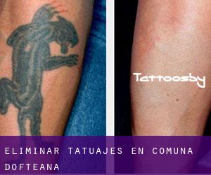 Eliminar tatuajes en Comuna Dofteana
