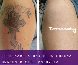 Eliminar tatuajes en Comuna Dragomireşti (Dâmboviţa)